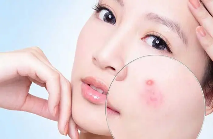 کورک پوستی روی گونه 644565654