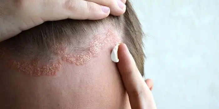 درماتیت سبوره روی پوست سر 79766767