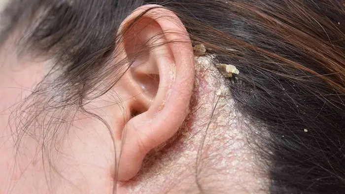 علائم درماتیت پشت گوش654433