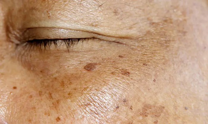 لکه های هیپرپیگمانتاسیون زیرچشم 778879798