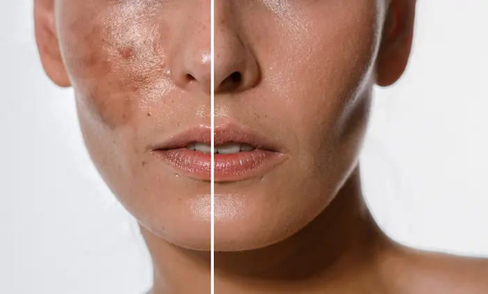 تاثیر برنج بر رنگ و لکه های پوستی 5654654