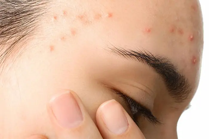ظاهر شدن جوش و تاثیر فست فود روی سلامت پوست 657565465