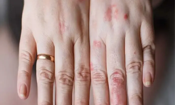 نشانه های خال سرطانی روی پوست دست 54654654