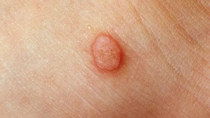 جای زخم و زگیل روی پوست 4674654