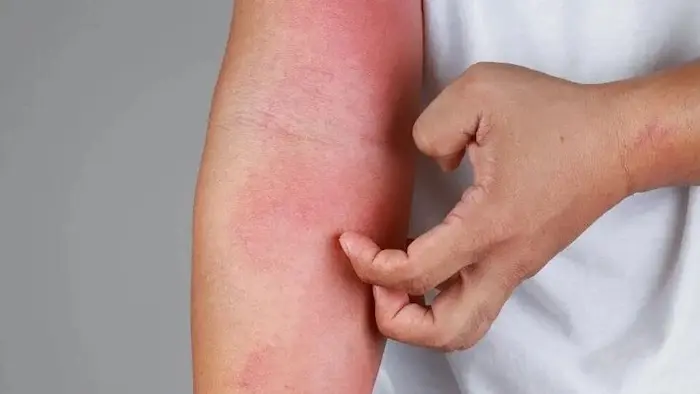 کهیر و رفع بیماری‌های پوستی در فصل گرما 76777870