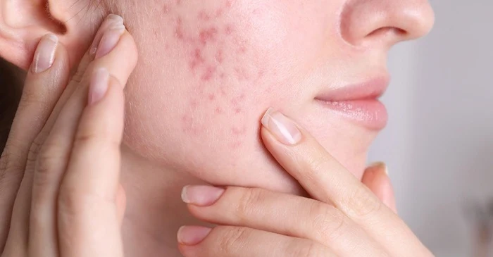 جوش و التهابات پوستی ناشی از استخر 654564550