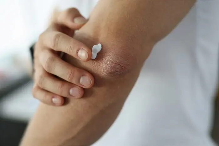 خشکی آرنح و ساعد 45343