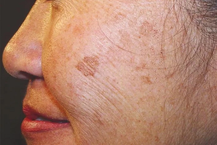 لک‌ های پوستی پس از یائسگی 568748546