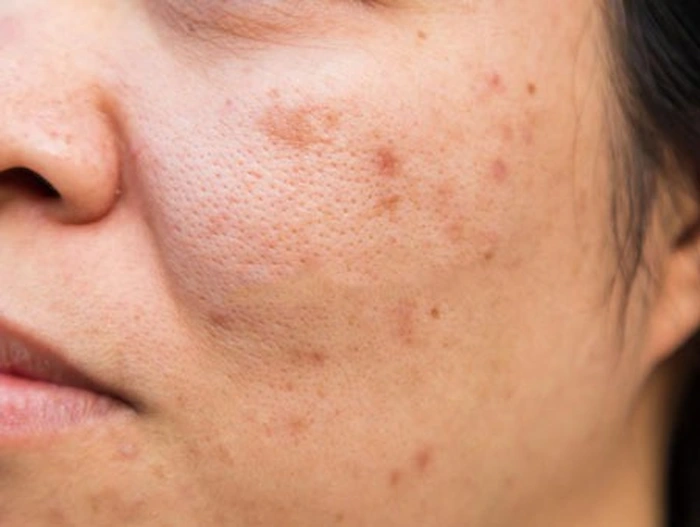 کمرنگ شدن لک‌ های پوستی پس از یائسگی 65456421